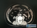 CT显示“腹主动脉夹层” - 安徽新闻网